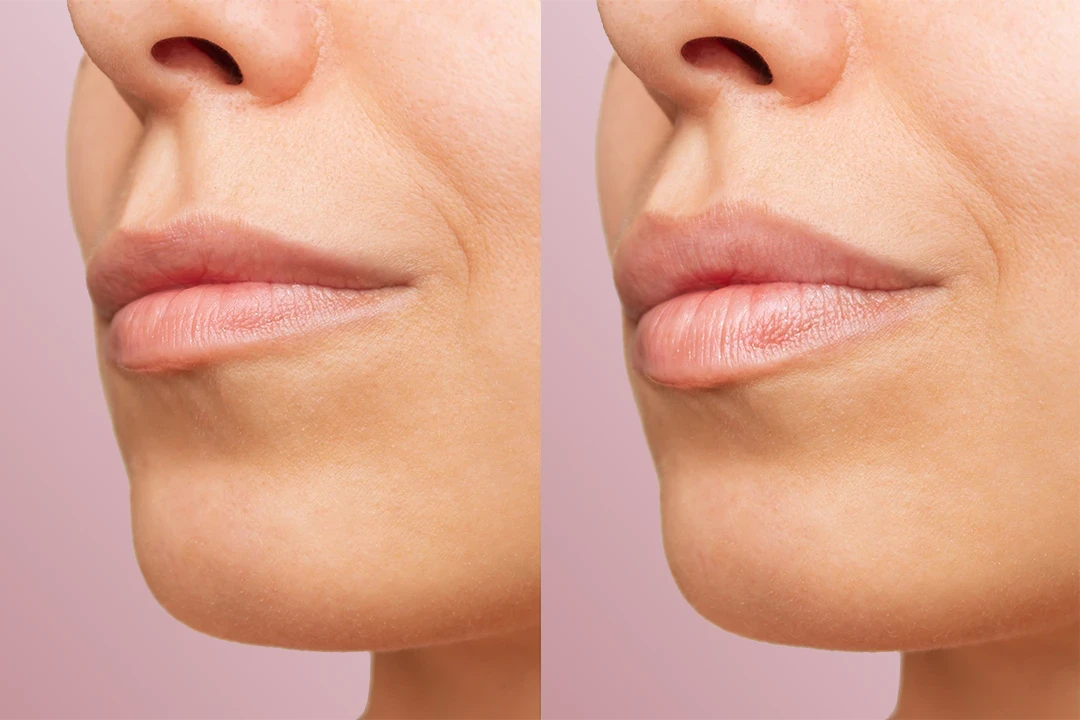 Lips Volumization